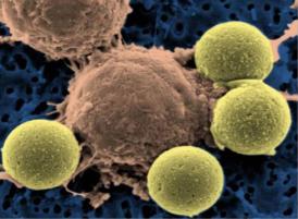 Image of T-cells attacking a cancer cell. Attrubtion.